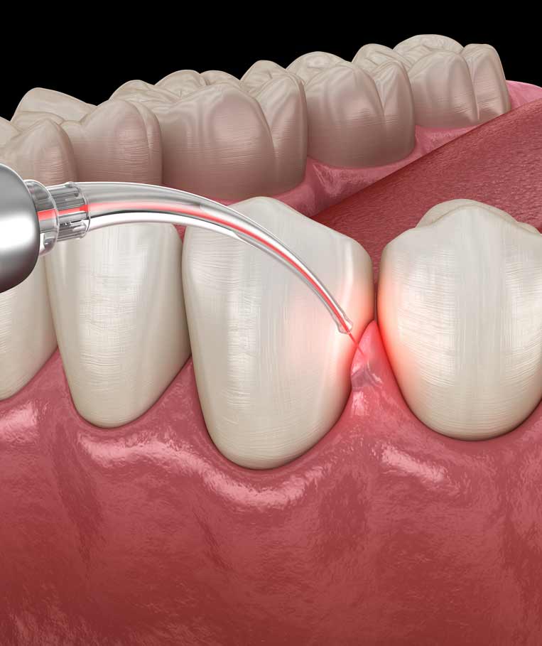 Gum correction surgery using laser at a dental clinic in Stafford, VA