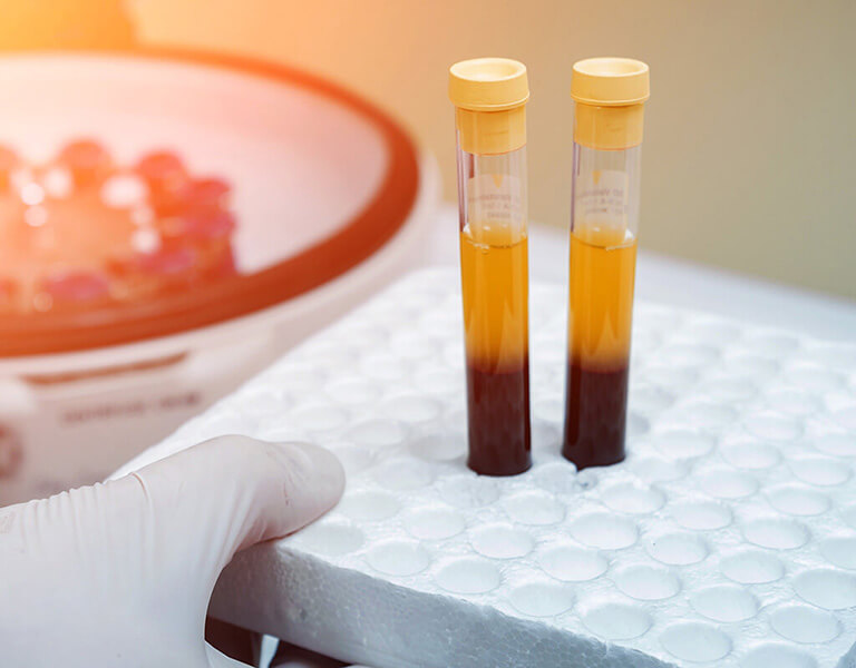 PRF (Platelet-Rich Fibrin) Therapy