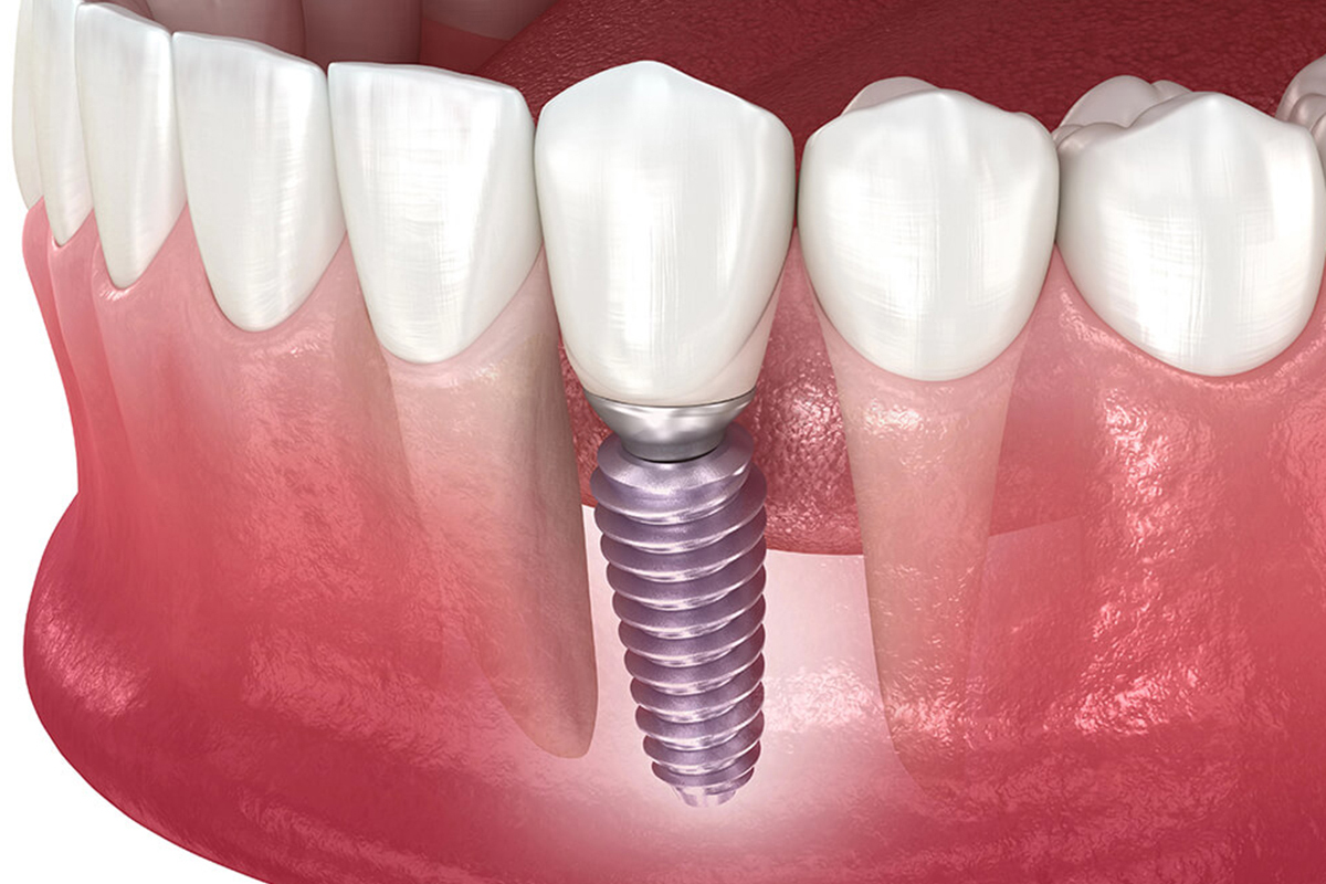 3D illustration of a ceramic dental implant with zirconia crown placed in gum and jawbone, showing titanium screw, abutment, and natural tooth integration ,Stafford, VA