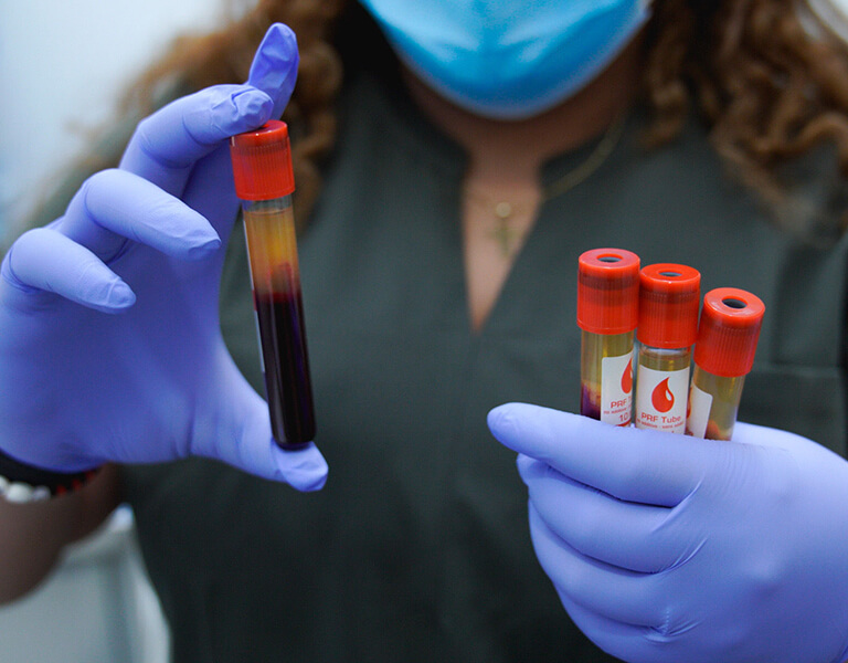 PRF (Platelet-Rich Fibrin) Therapy